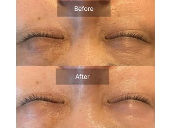 テセラ(TETHERA)/ナノテクノロジーフェイシャル