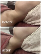 ココ センガ ビューティー クリニック(COCO SENGA Beauty-Clinic)/脂肪分解JET☆効果写真☆