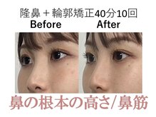 ラプリ 梅田店(Raplit)/隆鼻＋輪郭矯正40分10回