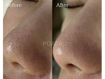 ポアラ(POARA)/毛穴/ワックス脱毛