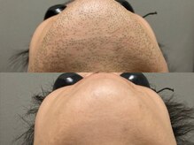 エミュ(emu formen)/髭脱毛で毛穴レス