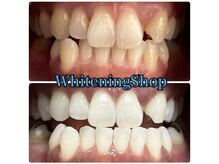 ホワイトニングショップ 津店/BeforeAfter