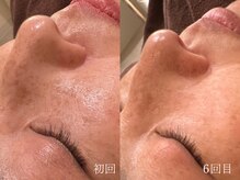 ウォーム(warm)/シミケア/美白/脱ピーリング