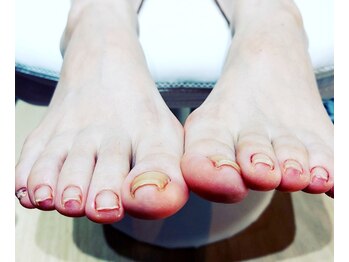 ソラ(sora)/先日巻き爪ケアでご来店☆