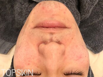 トップスキン 名駅(TOPSKIN)/本気のニキビ改善はお任せ下さい