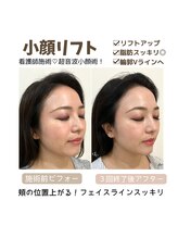 リスサロンドナース(LYS salon de Nurse)/小顔×超音波リフト【脂肪燃焼】