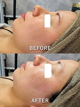 ルーク(Luke)/毛穴ケア