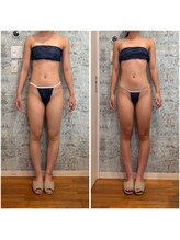 リモアボーテ(RIMOA beaute)/セルゼロ施術