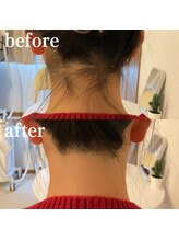 ミノア 大野城店(MINOA)/うなじ脱毛◆ビフォーアフター