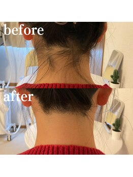 ミノア 大野城店(MINOA)/うなじ脱毛◆ビフォーアフター