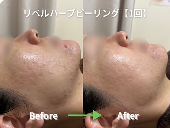 リソルバイスリール(Re:sol by sourire)/毛穴洗浄・ハーブピーリング専門