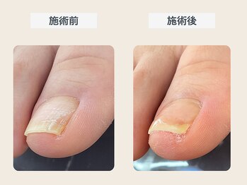 ルポ 伊勢/巻き爪ケア