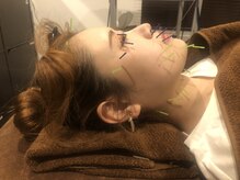 ロミハリ(LomiHari)/美容鍼