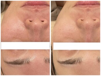 メゾンリュバン 梅田店(Maison Ruban)/ハーブピーリング・水光ジェット