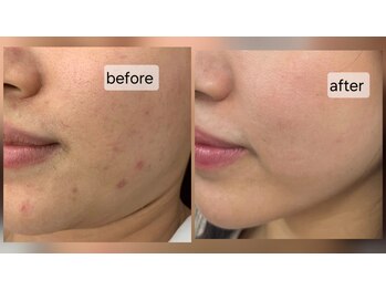 リラ 都城店(Lilas)/ハーブピーリング