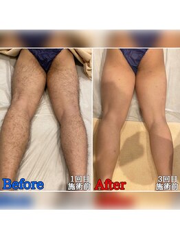 ファビー(Fabby)/メンズ脱毛★足全体のビフォアフ