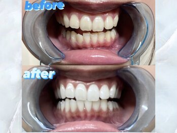 ライトケアサロン 銀座店(Light Care Salon)/セルフホワイトニングの症例写真