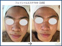 ひかり素肌/フェイシャルエステ70分 1回
