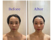 ハリーナ(HARI-NA)/美容鍼