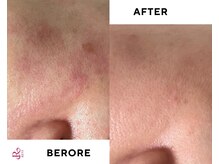 ゾーンビューティーハウス 柏店(ZONE BEAUTY HOUSE)/☆REVI陶肌トリートメント☆