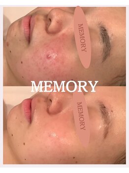 メモリー(MEMORY)/肌質が根本から改善☆