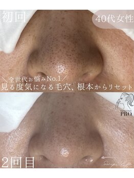 シードリン(Seedling)の写真/頑固な毛穴悩みに!毛穴エクストラクションプロで、つるんと輝く素肌美人へ導きます◎