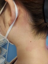 キアラ 麻布十番(Kiara)/うなじえりあし脱毛