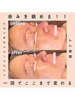 ピオニービューティー(Peony Beauty)/レストセルトリートメント