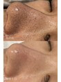 AK エステティックス(AK Esthetics)&nbsp;大人気毛穴洗浄もお任せください♪目指せ毛穴レス【#毛穴洗浄】