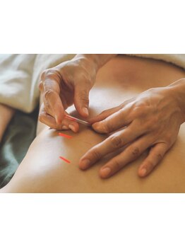 鍼灸施術を受けたい