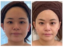 ルフルリール(Refleurir)/◇小顔コルギ症例◇