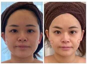 ルフルリール(Refleurir)/◇小顔コルギ症例◇