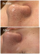 モテ 新宿店(Mote)/ハイドラ毛穴洗浄＋艶肌Wax 新宿