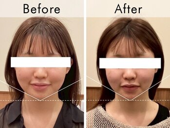 ハリラウンジ 恵比寿本店(Hari Lounge)/美容鍼専門サロン Hari Lounge