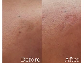 カシェット 広島店(Cachette)/50代女性☆韓国発最新シミケア