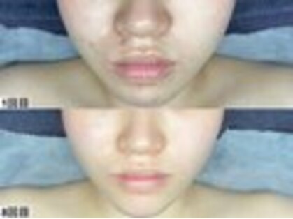 ハーブピーリング×韓国肌管理 &me名駅【アンドミー】ララピール/毛穴洗浄/ニキビケアの写真