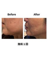 ティアレソワン(tiare soin)/たるみむくみフェイスライン改善