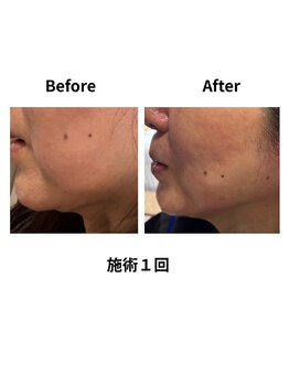 ティアレソワン(tiare soin)/たるみむくみフェイスライン改善