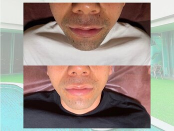 ベルゼ 渋谷店(BELZE)/男性ヒゲ脱毛♪