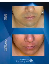 ルミーク(Lumique)/Before After N様