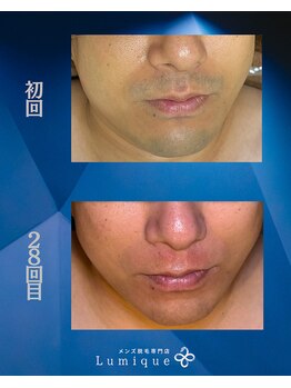 ルミーク(Lumique)/Before After N様