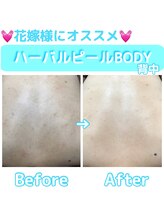 エステティックサロン リアス(Rias)/ハーバルピールBODY