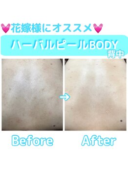 エステティックサロン リアス(Rias)/ハーバルピールBODY