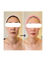 リオラ ビューティー(Liora beauty)/《before/after》