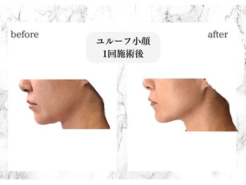 トキ(TOKI)/ユルーフ超音波小顔リフト 直後