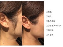 ピュアノア 垂水店/産毛脱毛　顔脱毛　神戸垂水明石