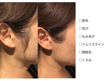 ピュアノア 垂水店/産毛脱毛　顔脱毛　神戸垂水明石