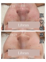リブラン(Libran)/繰り返す赤み・ニキビの改善に★