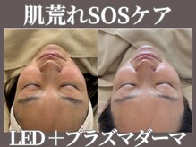 マヴィ 藤井寺店(MavY.)/肌荒れのお悩みにはLED