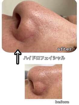 ミラリア(mirallia)の写真/肌悩みに寄り添う、ハイドロフェイシャル(毛穴洗浄)&ハーブピーリング♪